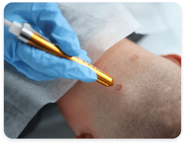 Видалення папілом лазером Київ – ціна у клініці Di Clinic 8
